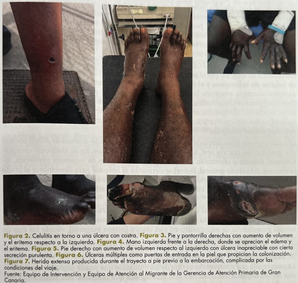 Infecciones de la piel y partes blandas: pie/mano de patera. Fuente: Atención a Pacientes Migrantes, semFYC