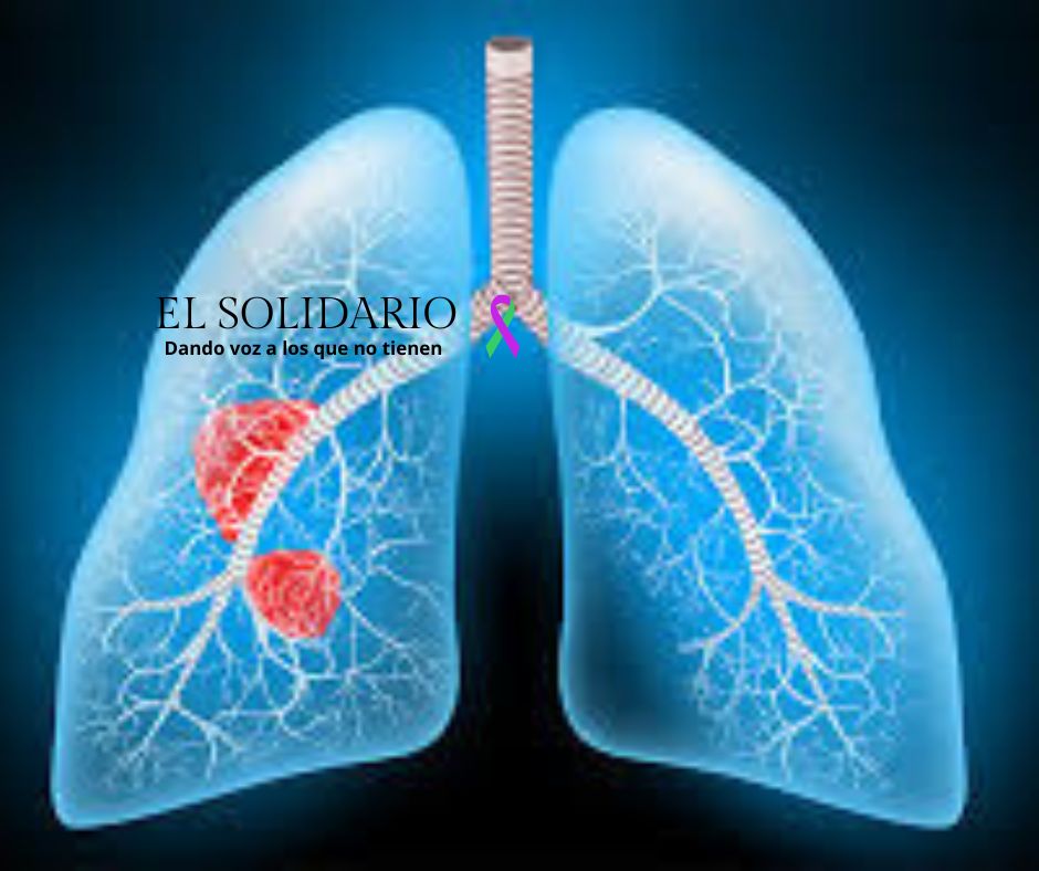 Cáncer de pulmón de célula pequeña